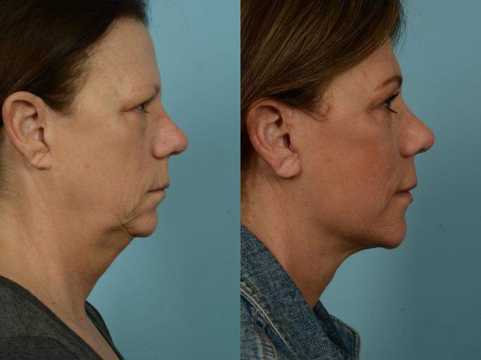 Before & After Facelift/Minilift by Dr. Mustoe Case 973 Right Side View in Chicago, IL