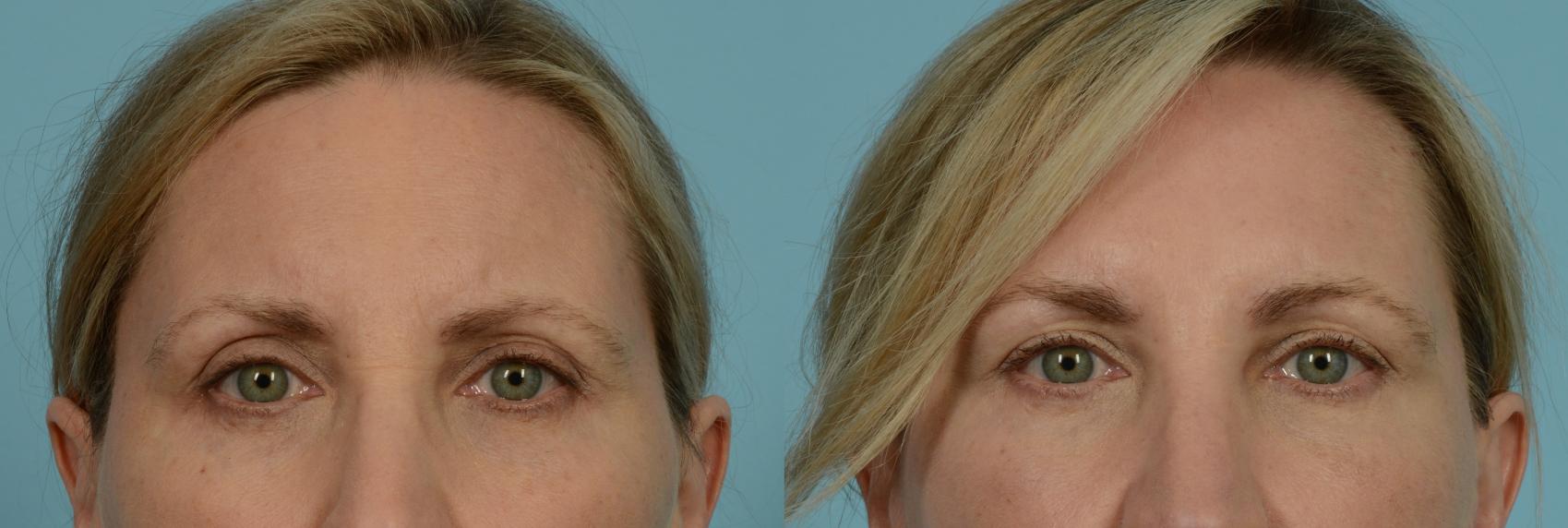 Before & After Fat Grafting by Dr. Mustoe Case 979 Forehead View in Chicago, IL