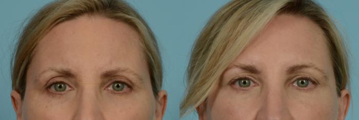 Before & After Fat Grafting by Dr. Mustoe Case 979 Forehead View in Chicago, IL