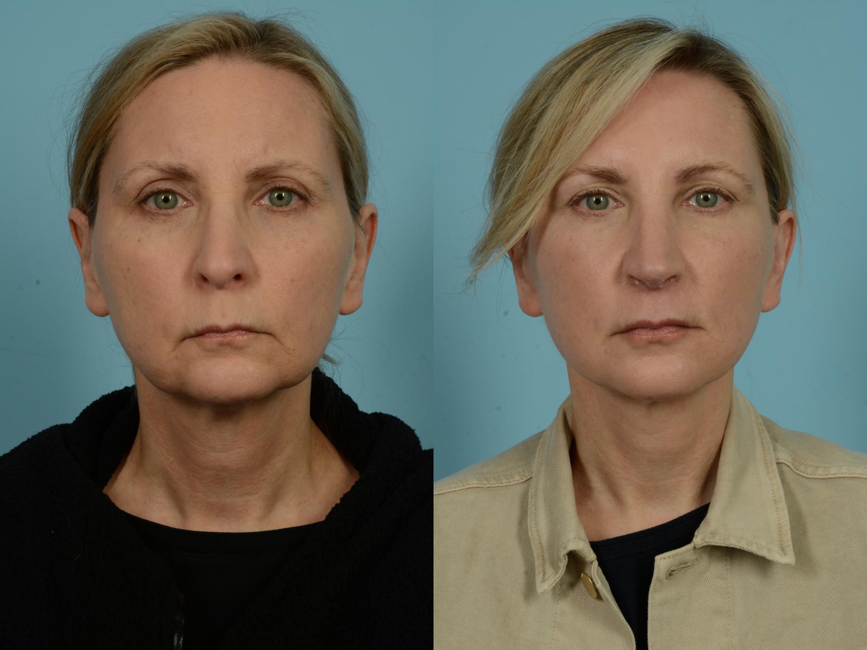 Before & After Facelift/Minilift by Dr. Mustoe Case 979 Front View in Chicago, IL