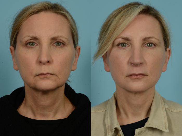 Before & After Fat Grafting by Dr. Mustoe Case 979 Front View in Chicago, IL