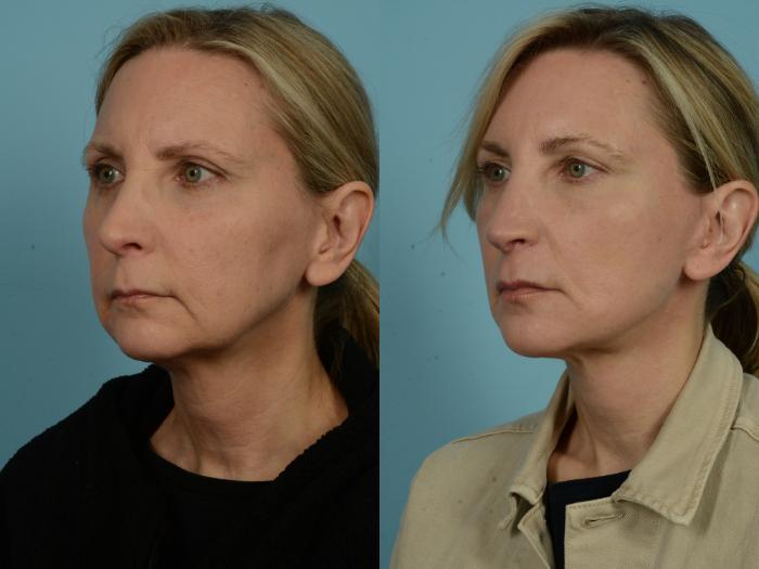 Before & After Facelift/Minilift by Dr. Mustoe Case 979 Left Oblique View in Chicago, IL