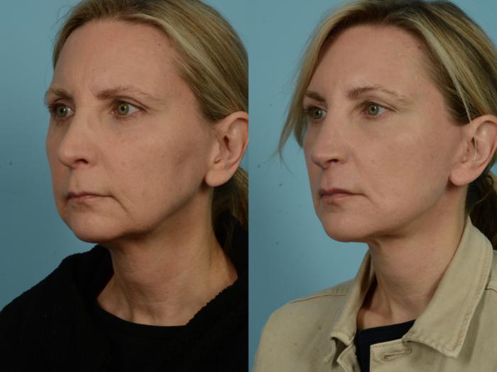 Before & After Neck Lift by Dr. Mustoe Case 979 Left Oblique View in Chicago, IL