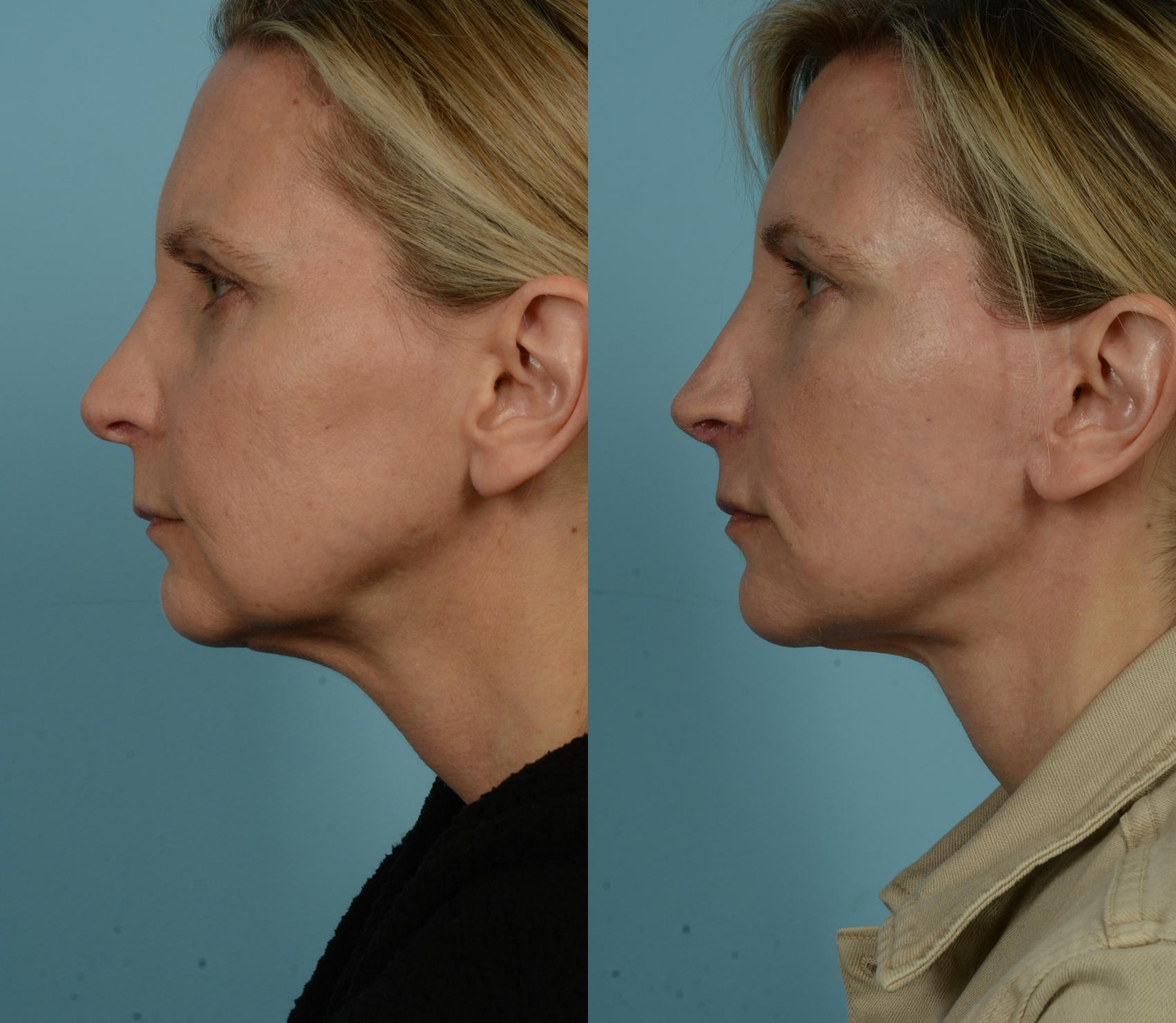 Before & After Fat Grafting by Dr. Mustoe Case 979 Left Side View in Chicago, IL