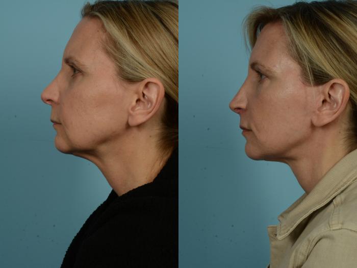 Before & After Facelift/Minilift by Dr. Mustoe Case 979 Left Side View in Chicago, IL