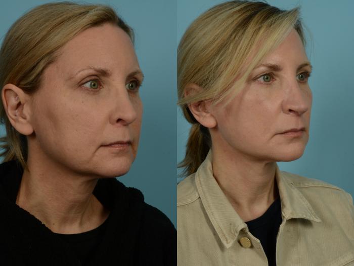 Before & After Facelift/Minilift by Dr. Mustoe Case 979 Right Oblique View in Chicago, IL