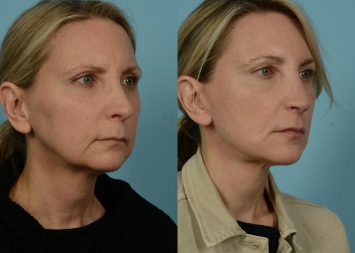 Before & After Neck Lift by Dr. Mustoe Case 979 Right Oblique View in Chicago, IL