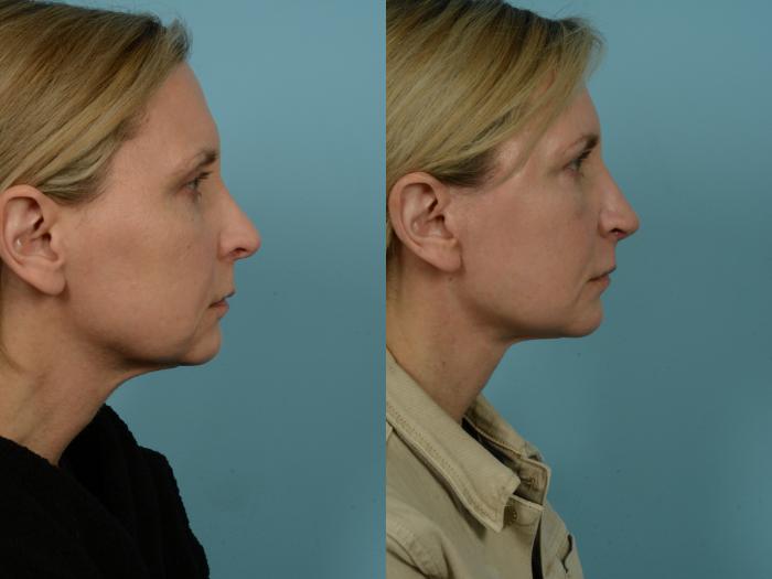 Before & After Facelift/Minilift by Dr. Mustoe Case 979 Right Side View in Chicago, IL