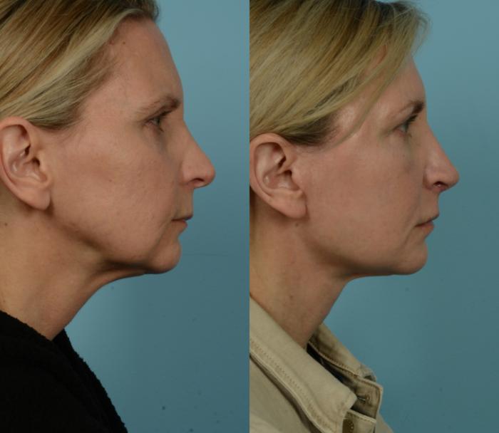 Before & After Fat Grafting by Dr. Mustoe Case 979 Right Side View in Chicago, IL