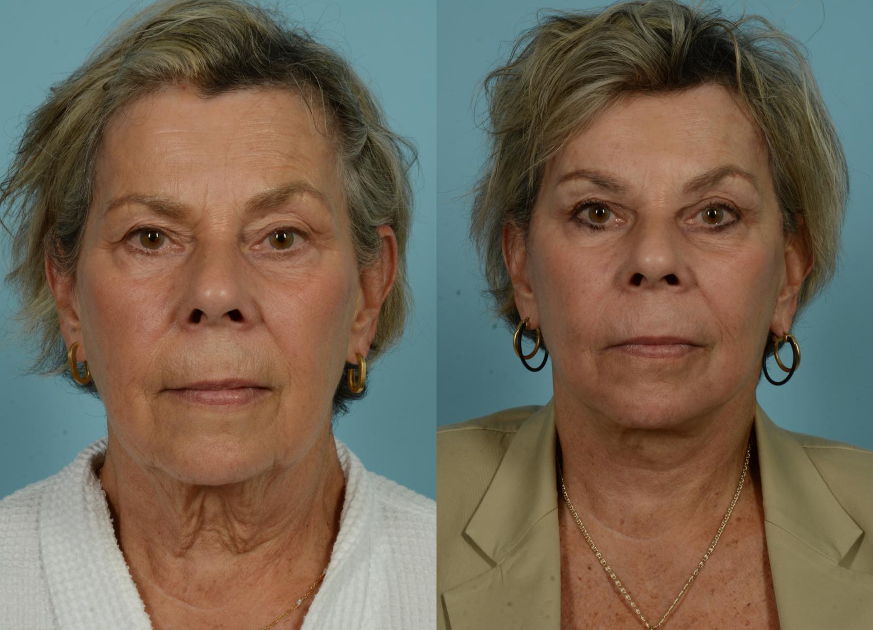 Before & After Deep Plane Facelift by Dr. Mustoe Case 997 Front View in Chicago, IL
