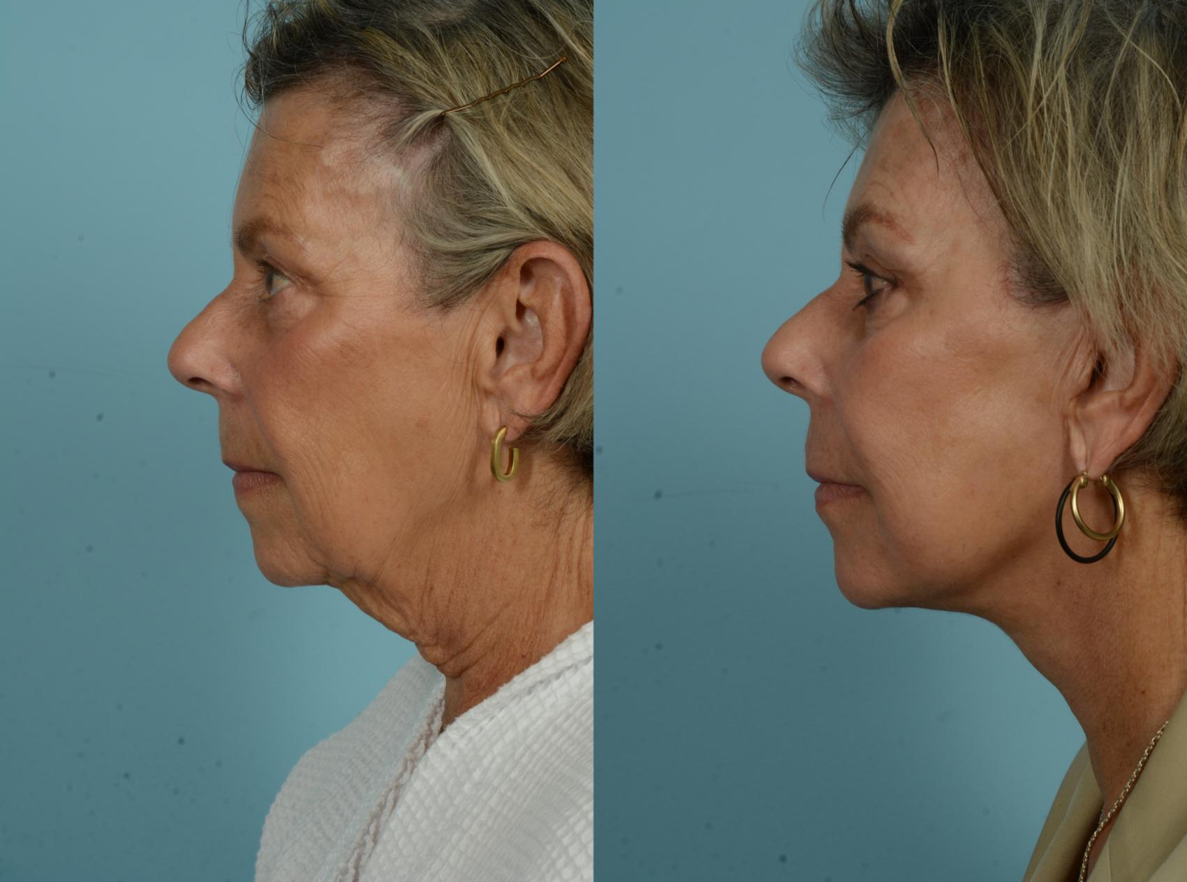 Before & After Neck Lift by Dr. Mustoe Case 997 Left Side View in Chicago, IL