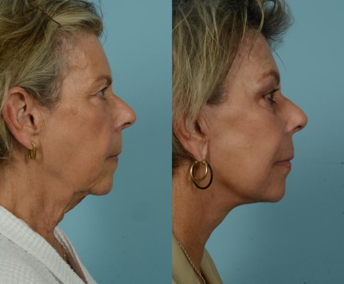 Before & After Neck Lift by Dr. Mustoe Case 997 Right Side View in Chicago, IL