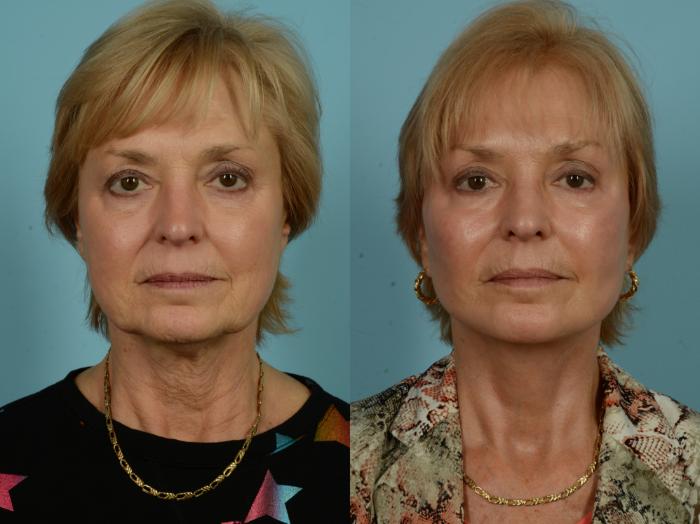 Before & After Midface Lift by Dr. Sinno Case 1010 Front View in Chicago, IL