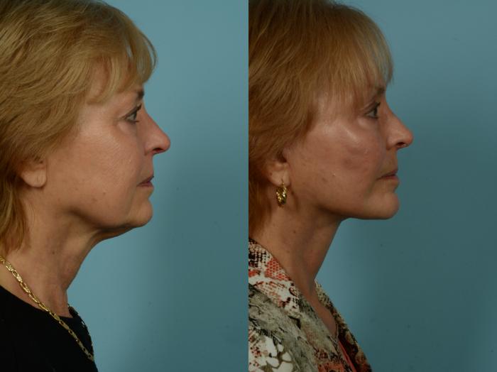 Before & After Facelift/Minilift by Dr. Sinno Case 1010 Right Side View in Chicago, IL