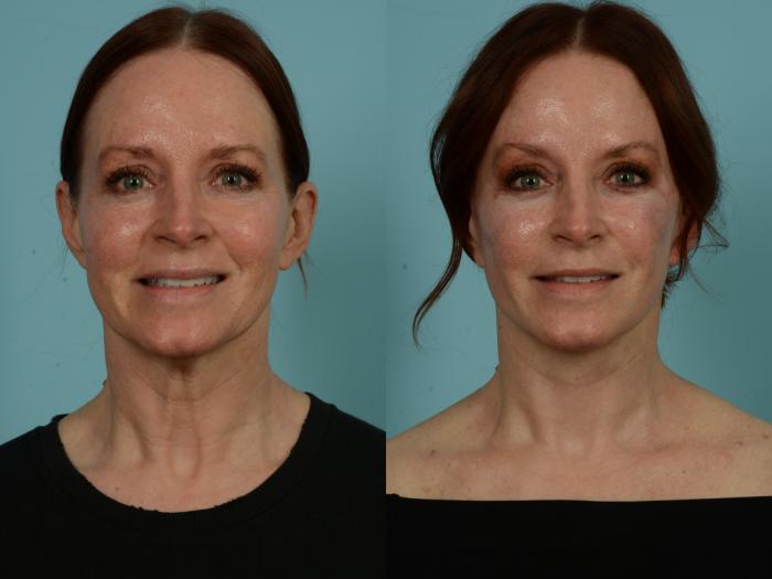 Before & After Facelift/Minilift by Dr. Sinno Case 1011 Front View in Chicago, IL