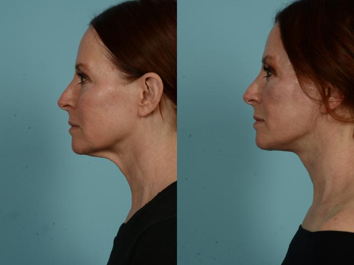 Before & After Facelift/Minilift by Dr. Sinno Case 1011 Left Side View in Chicago, IL