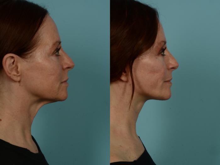 Before & After Neck Lift by Dr. Sinno Case 1011 Right Side View in Chicago, IL