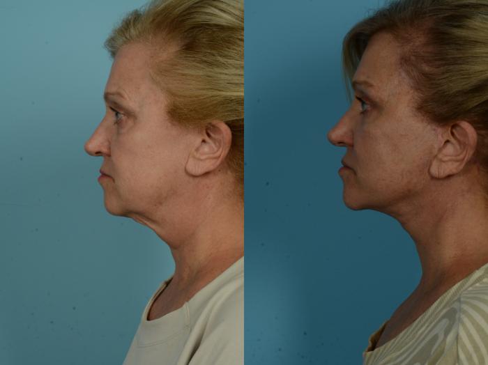 Before & After Facelift/Minilift by Dr. Sinno Case 1037 Left Side View in Chicago, IL