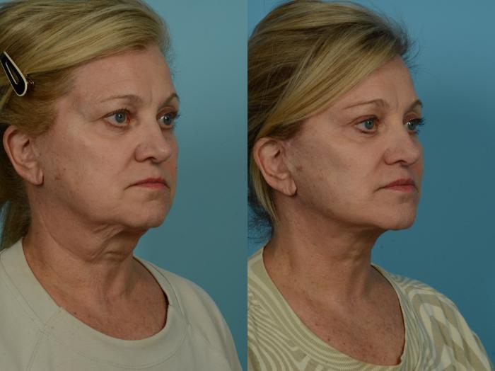 Before & After Facelift/Minilift by Dr. Sinno Case 1037 Right Oblique View in Chicago, IL