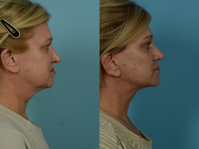 Before & After Facelift/Minilift by Dr. Sinno Case 1037 Right Side View in Chicago, IL