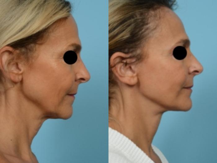 Dr. Sinno Facelift in Chicago, Illinois