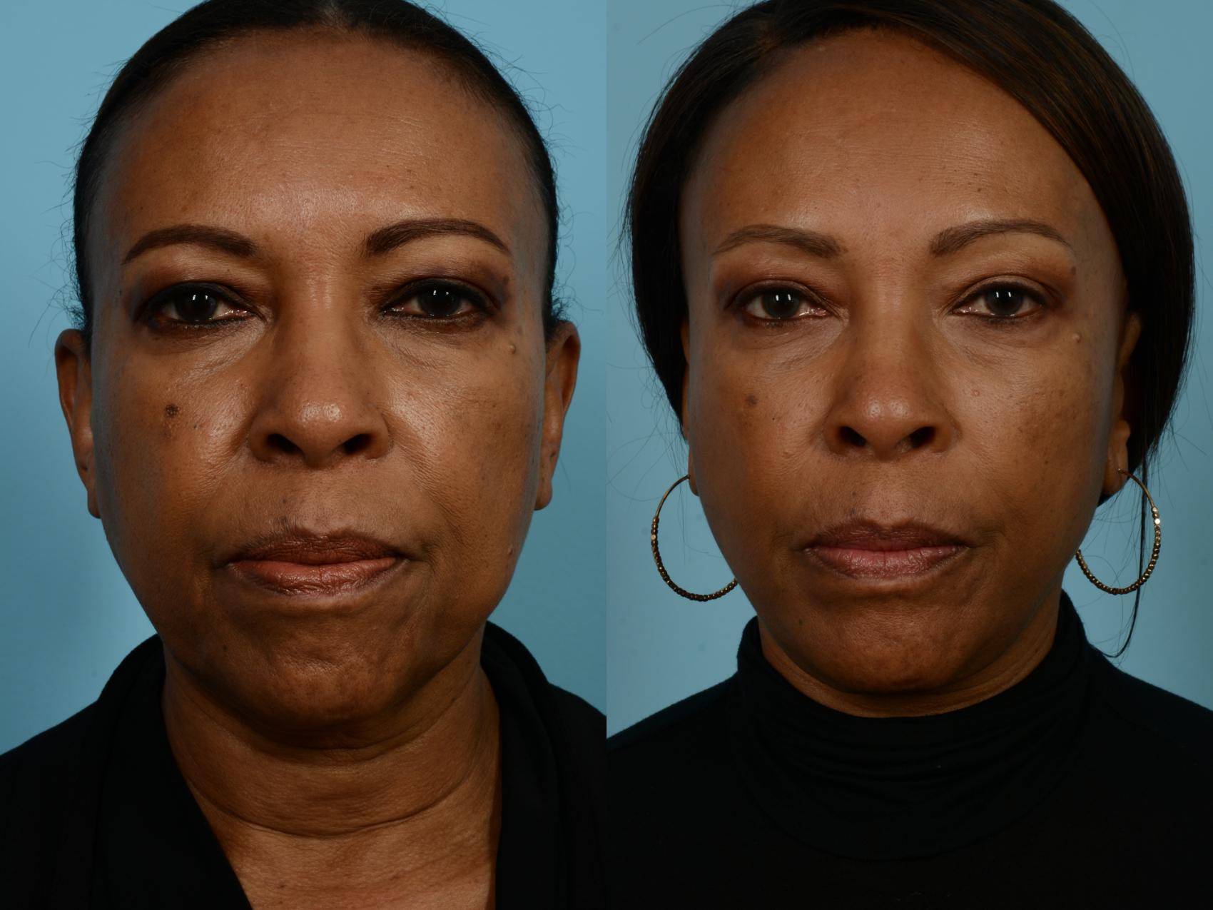 Facelift/Minilift by Dr. Sinno Before and After Pictures Case 690 ...