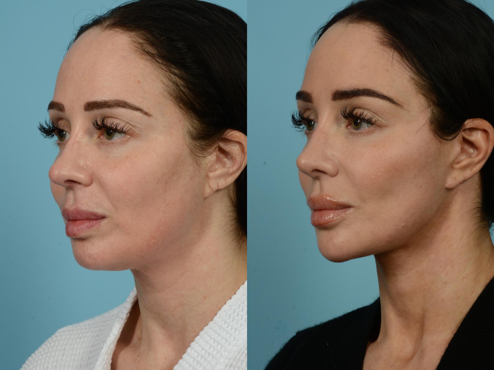 Before & After Facelift/Minilift by Dr. Sinno Case 741 Left Oblique View in Chicago, IL