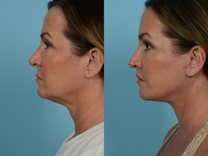 Dr. Sinno Facelift in Chicago, Illinois