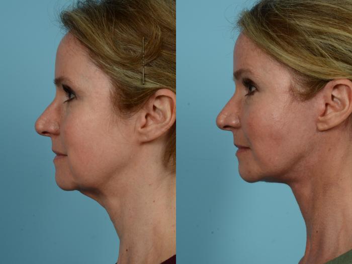 Before & After Facelift/Minilift by Dr. Sinno Case 756 Left Side View in Chicago, IL