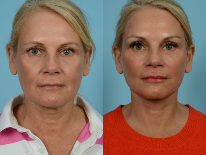 Before & After Facelift/Minilift by Dr. Sinno Case 780 Front View in Chicago, IL