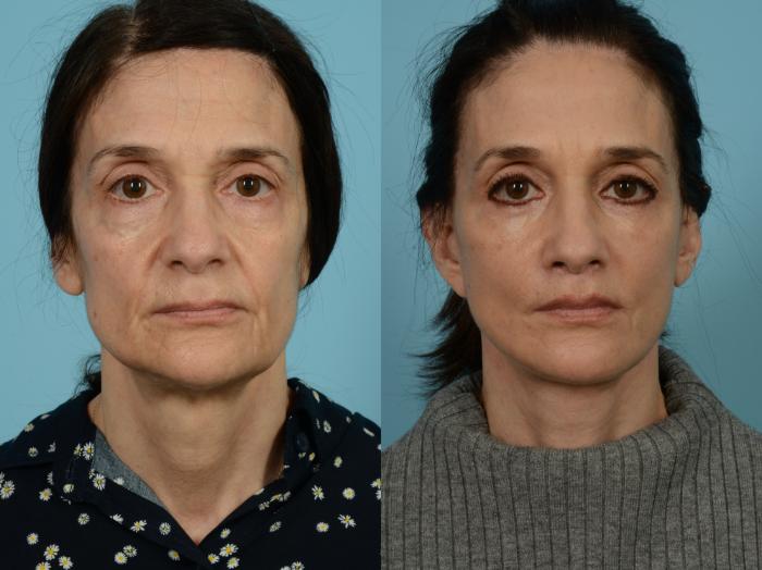 Before & After Midface Lift by Dr. Sinno Case 803 Front View in Chicago, IL