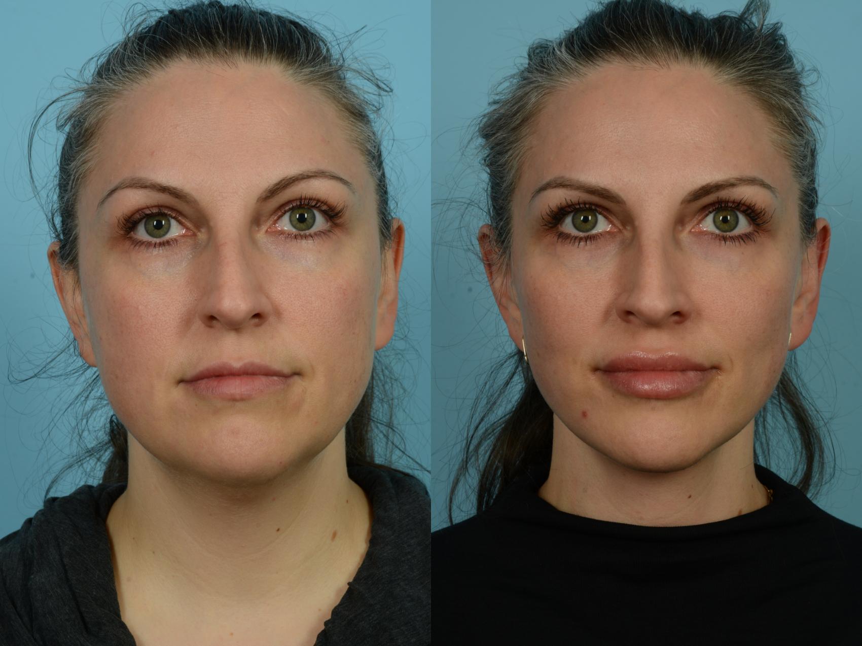 Before & After Facelift/Minilift by Dr. Sinno Case 843 Front View in Chicago, IL