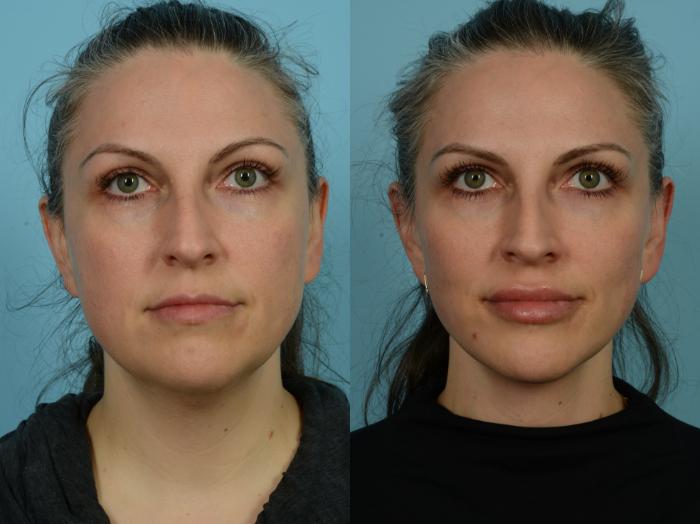 Before & After Facelift/Minilift by Dr. Sinno Case 843 Front View in Chicago, IL