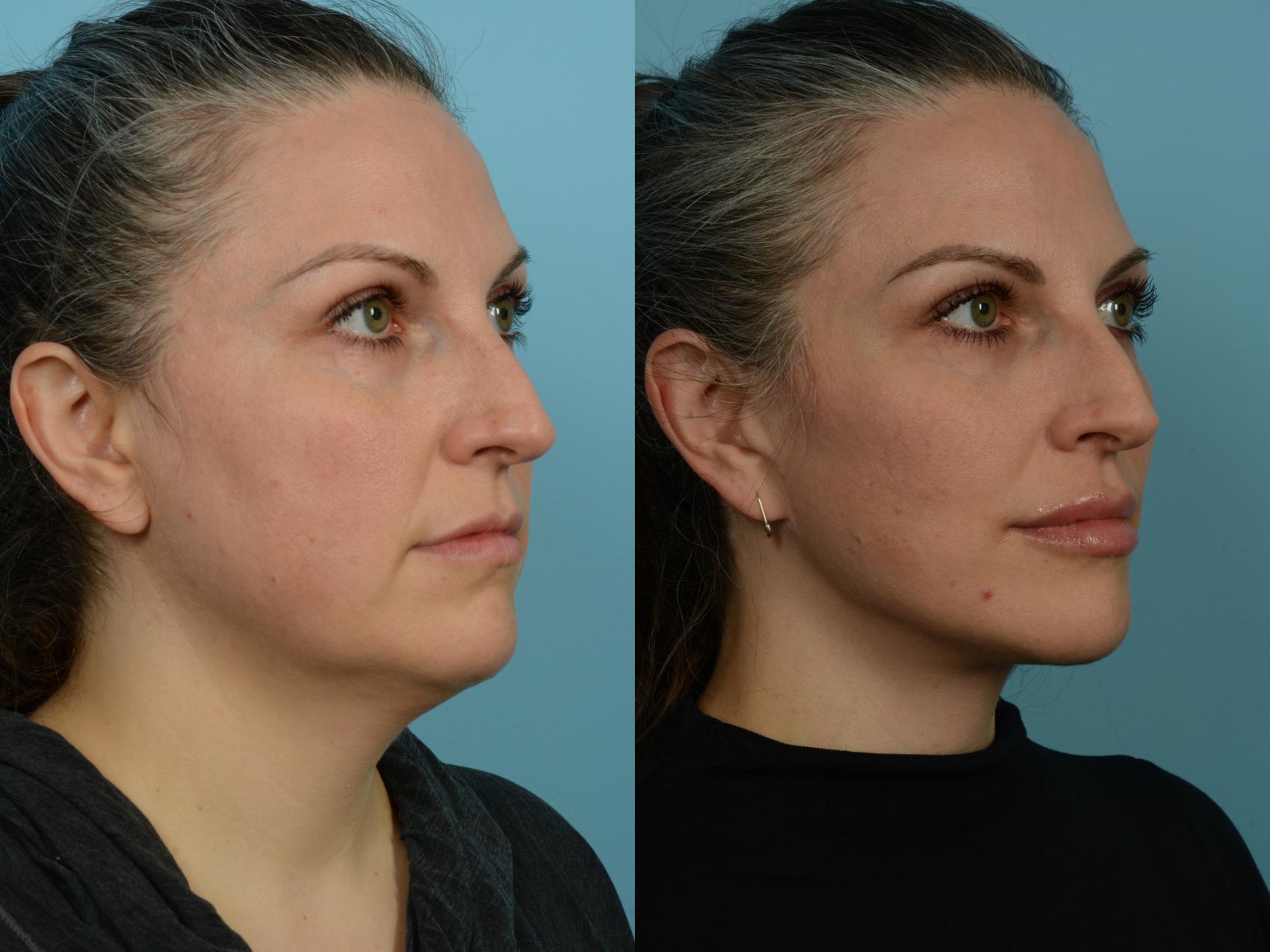 Before & After Neck Lift by Dr. Sinno Case 843 Right Oblique View in Chicago, IL