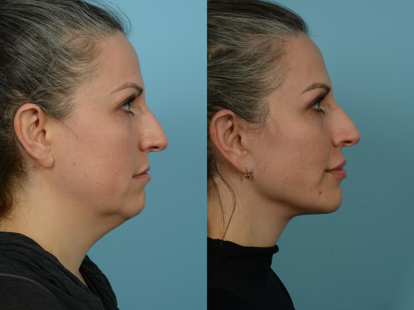 Before & After Dual Plane Facelift by Dr. Sinno Case 843 Right Side View in Chicago, IL