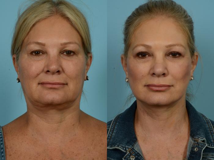 Before & After Midface Lift by Dr. Sinno Case 869 Front View in Chicago, IL