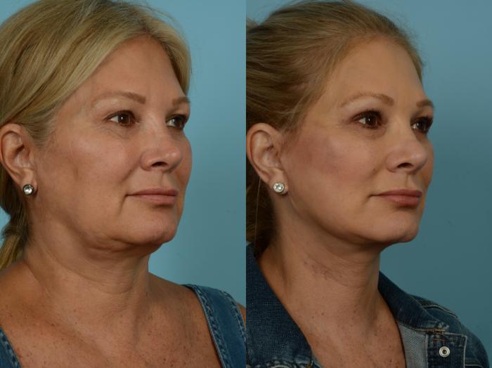 Before & After Facelift/Minilift by Dr. Sinno Case 869 Right Oblique View in Chicago, IL