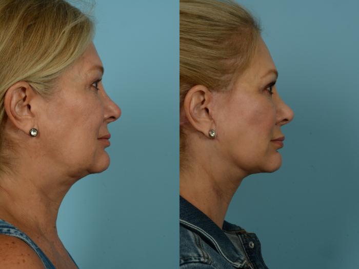 Before & After Midface Lift by Dr. Sinno Case 869 Right Side View in Chicago, IL