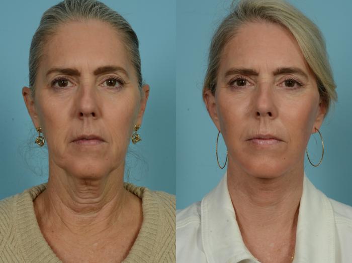 Before & After Midface Lift by Dr. Sinno Case 876 Front View in Chicago, IL