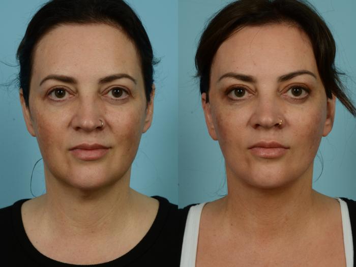 Before & After Neck Lift by Dr. Sinno Case 877 Front View in Chicago, IL