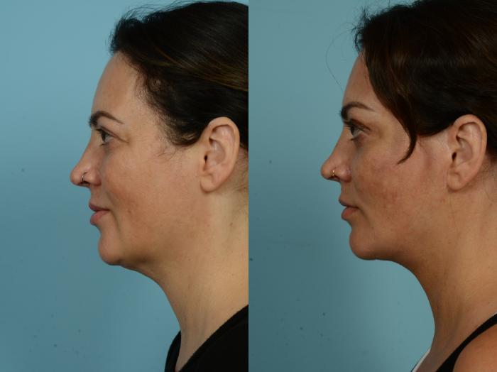Before & After Neck Lift by Dr. Sinno Case 877 Left Side View in Chicago, IL