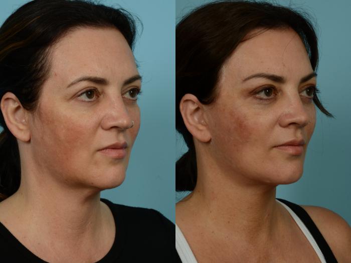 Before & After Neck Lift by Dr. Sinno Case 877 Right Oblique View in Chicago, IL
