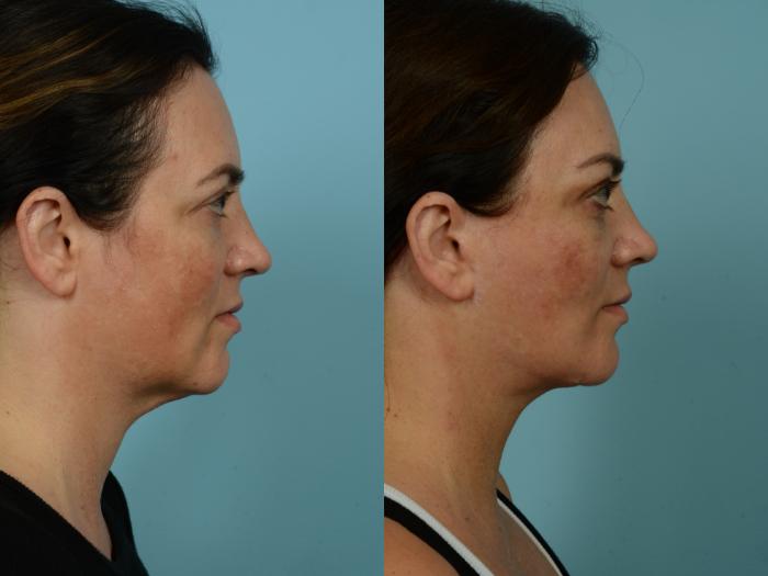 Before & After Neck Lift by Dr. Sinno Case 877 Right Side View in Chicago, IL