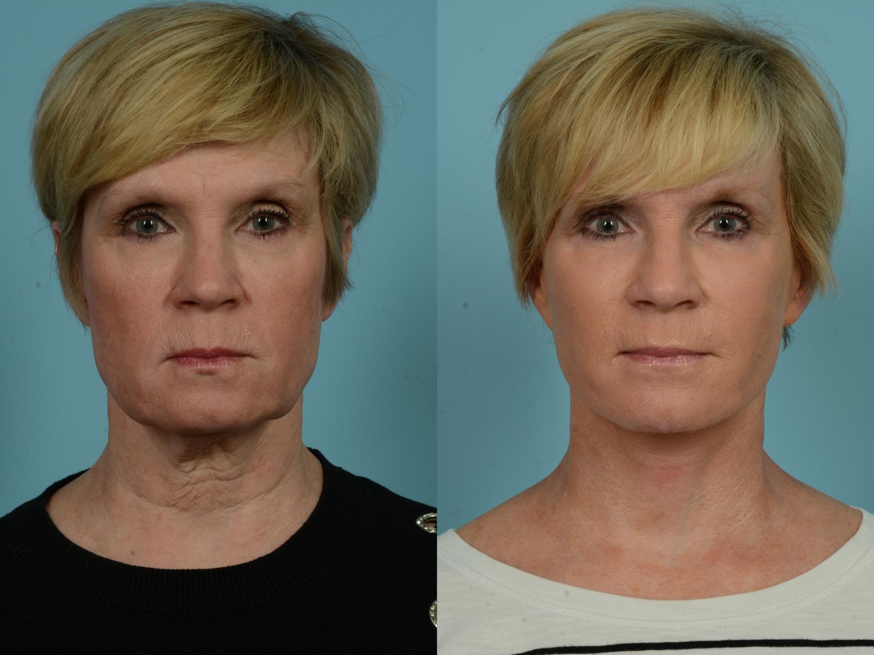 Before & After Neck Lift by Dr. Sinno Case 880 Front View in Chicago, IL