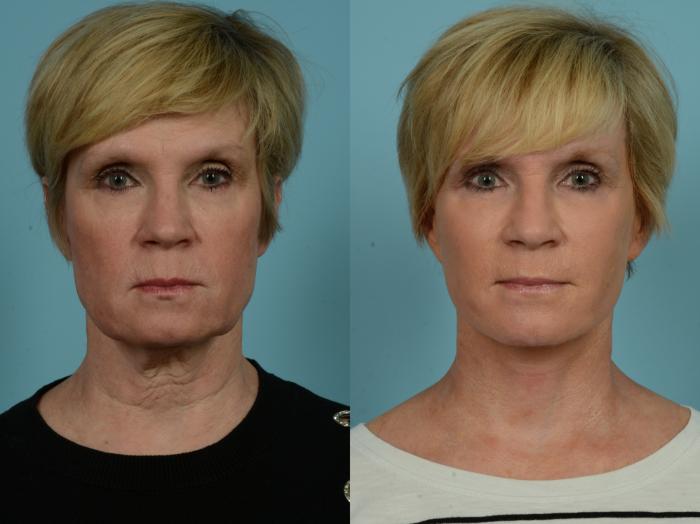 Before & After Facelift/Minilift by Dr. Sinno Case 880 Front View in Chicago, IL