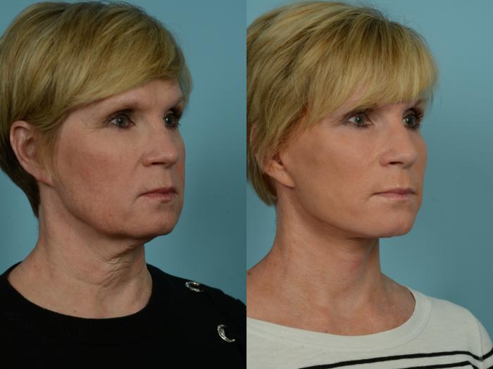 Before & After Neck Lift by Dr. Sinno Case 880 Right Oblique View in Chicago, IL