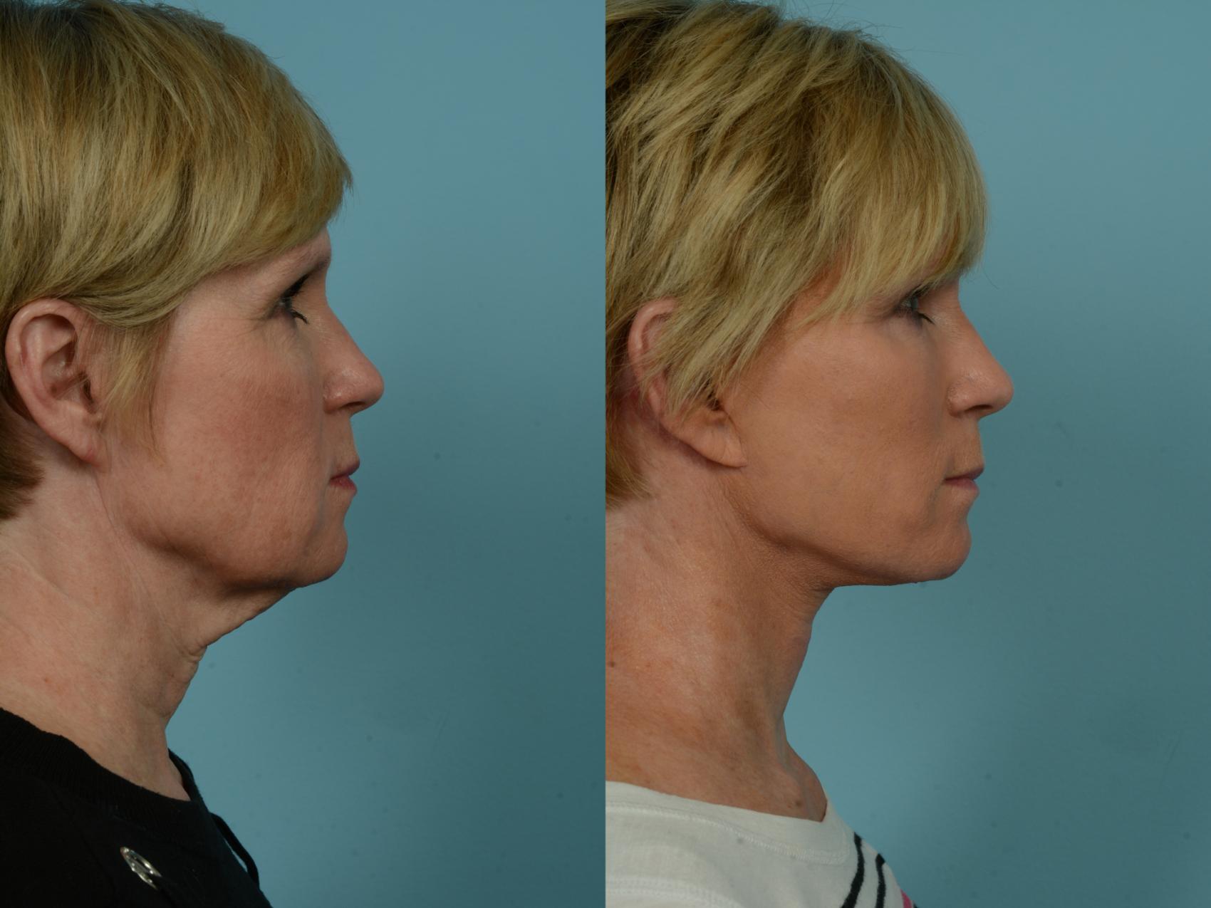 Before & After Dual Plane Facelift by Dr. Sinno Case 880 Right Side View in Chicago, IL