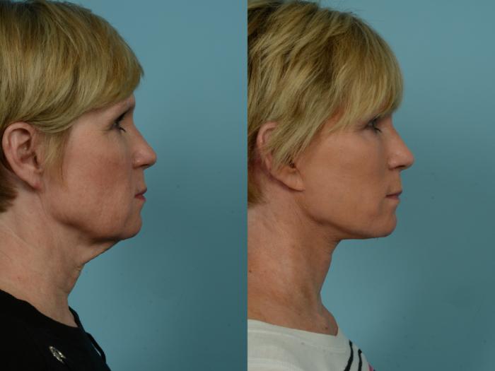Before & After Neck Lift by Dr. Sinno Case 880 Right Side View in Chicago, IL