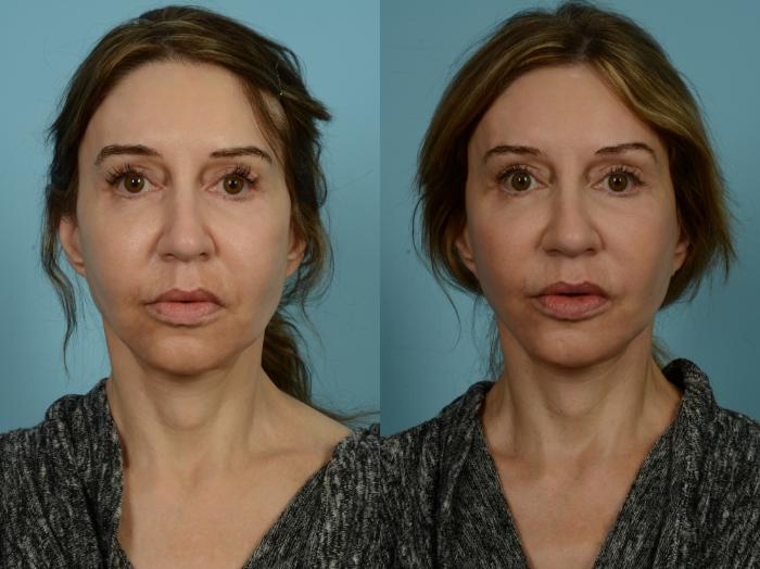 Before & After Facelift/Minilift by Dr. Sinno Case 906 Front View in Chicago, IL