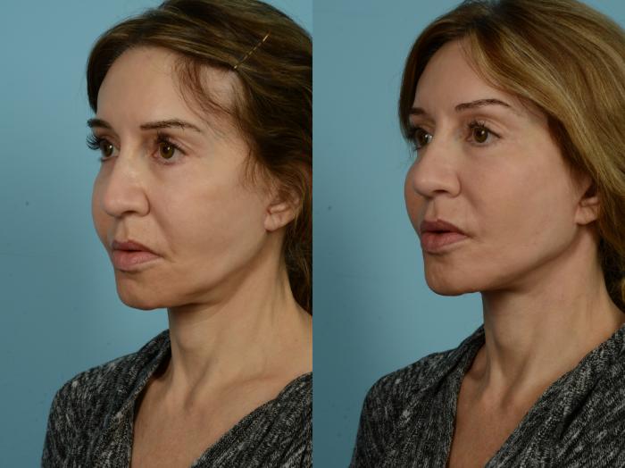 Before & After Facelift/Minilift by Dr. Sinno Case 906 Left Oblique View in Chicago, IL